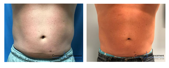 Male Coolsculpting Transformation at CECofNE 