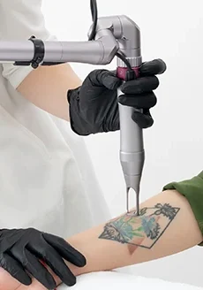 laser tattoo removal