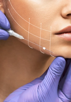 thread lift placement in jowls