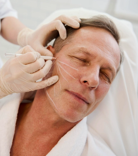 aesthetician drawing markings on man's face in preparation for thread lift